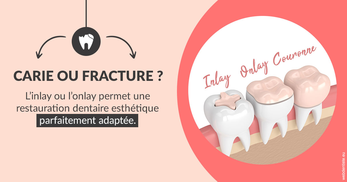 https://www.dentistes-bouaziz.fr/T2 2023 - Carie ou fracture 2
