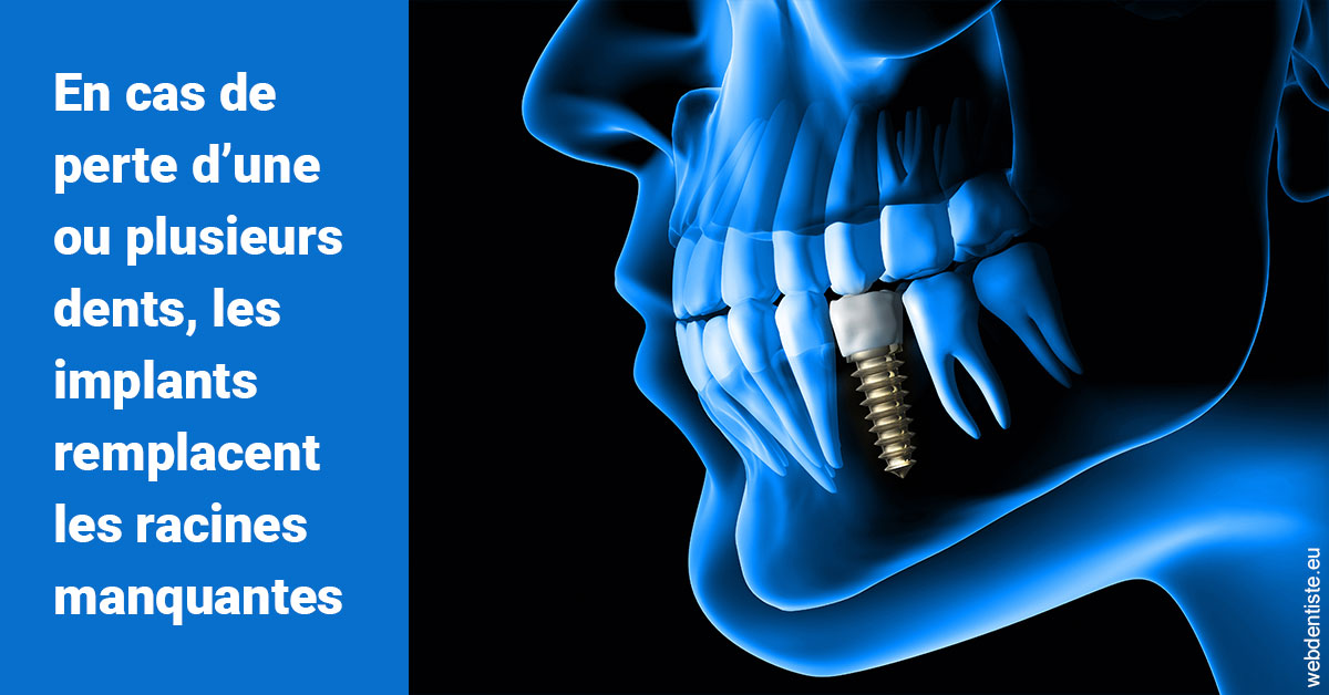https://www.dentistes-bouaziz.fr/Les implants 1