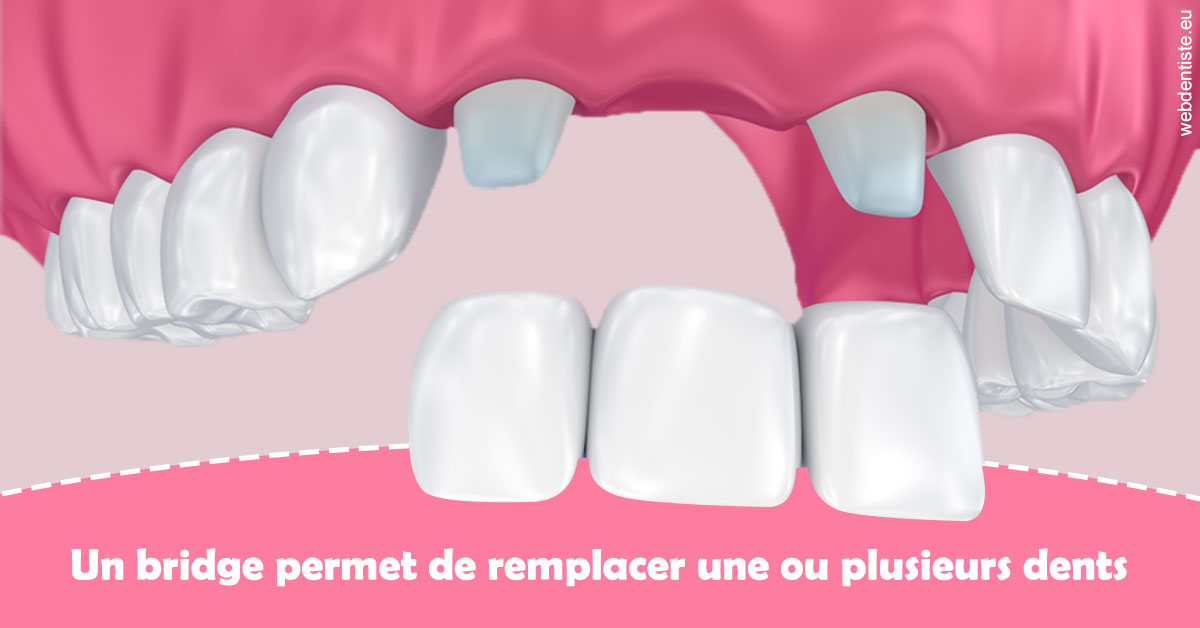 https://www.dentistes-bouaziz.fr/Bridge remplacer dents 2
