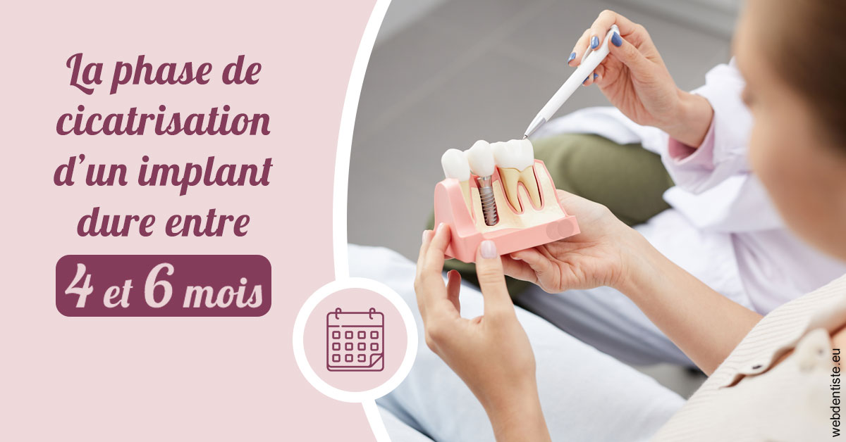 https://www.dentistes-bouaziz.fr/Cicatrisation implant 2