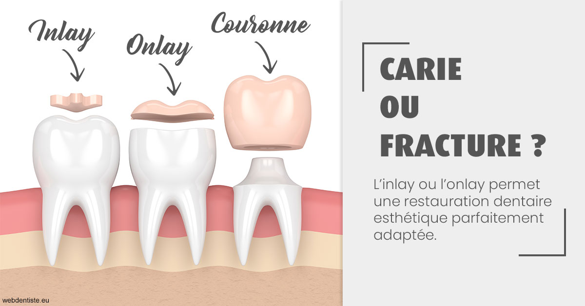 https://www.dentistes-bouaziz.fr/T2 2023 - Carie ou fracture 1