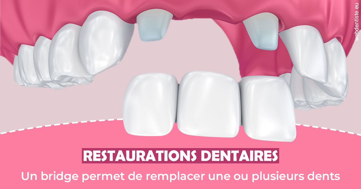 https://www.dentistes-bouaziz.fr/Bridge remplacer dents 2