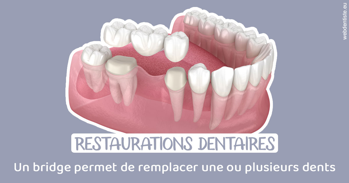 https://www.dentistes-bouaziz.fr/Bridge remplacer dents 1
