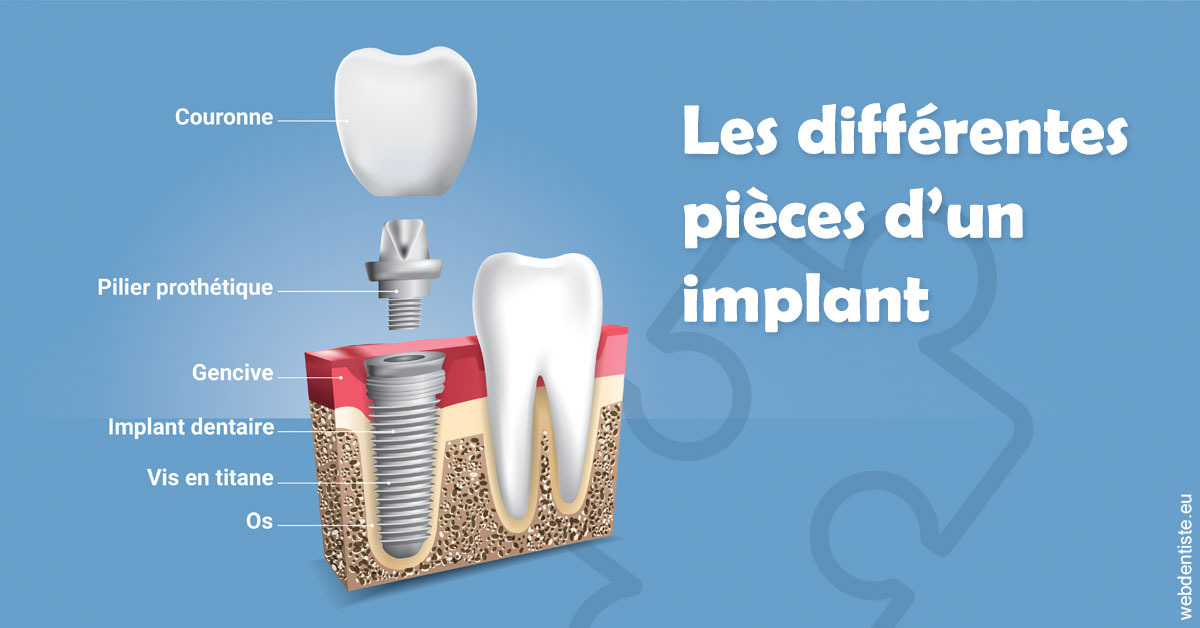 https://www.dentistes-bouaziz.fr/Les différentes pièces d’un implant 1